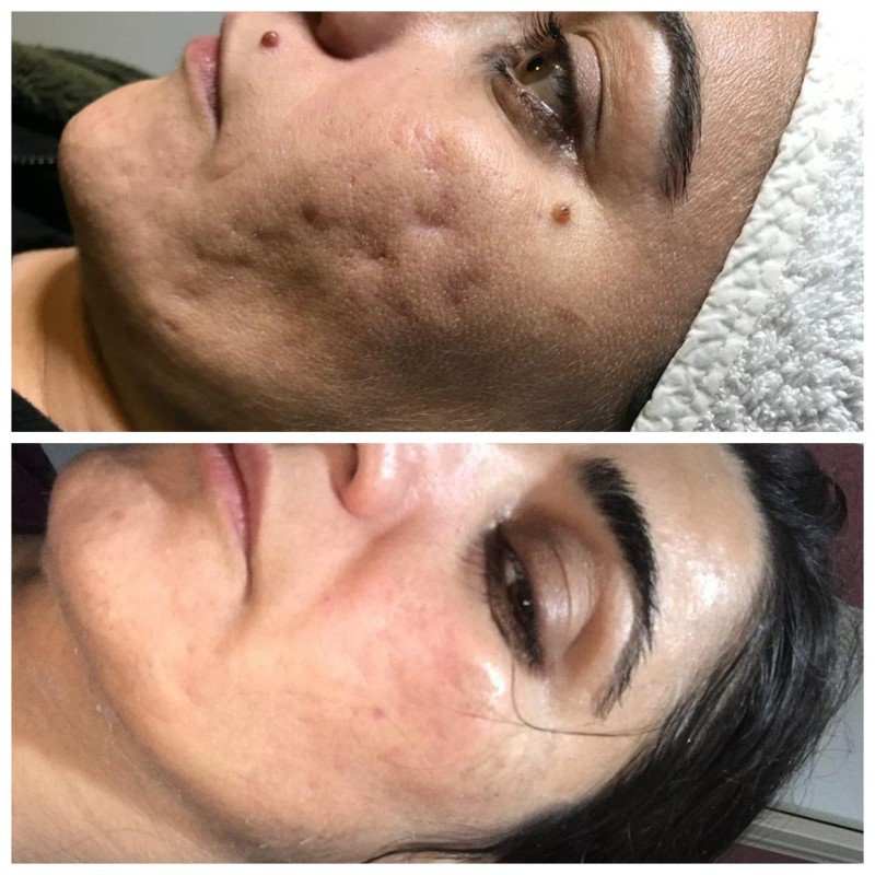 Cilt bakımı lazer epilasyon bölgesel incelme kirpik lifting iğneli epilasyon - Fotoğraf 1